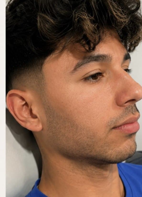 Clearer skin after the Blemiderm acne programme at SKN Luxe