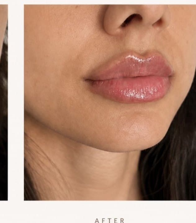 Natural lip enhancement results at SKN Luxe Manchester