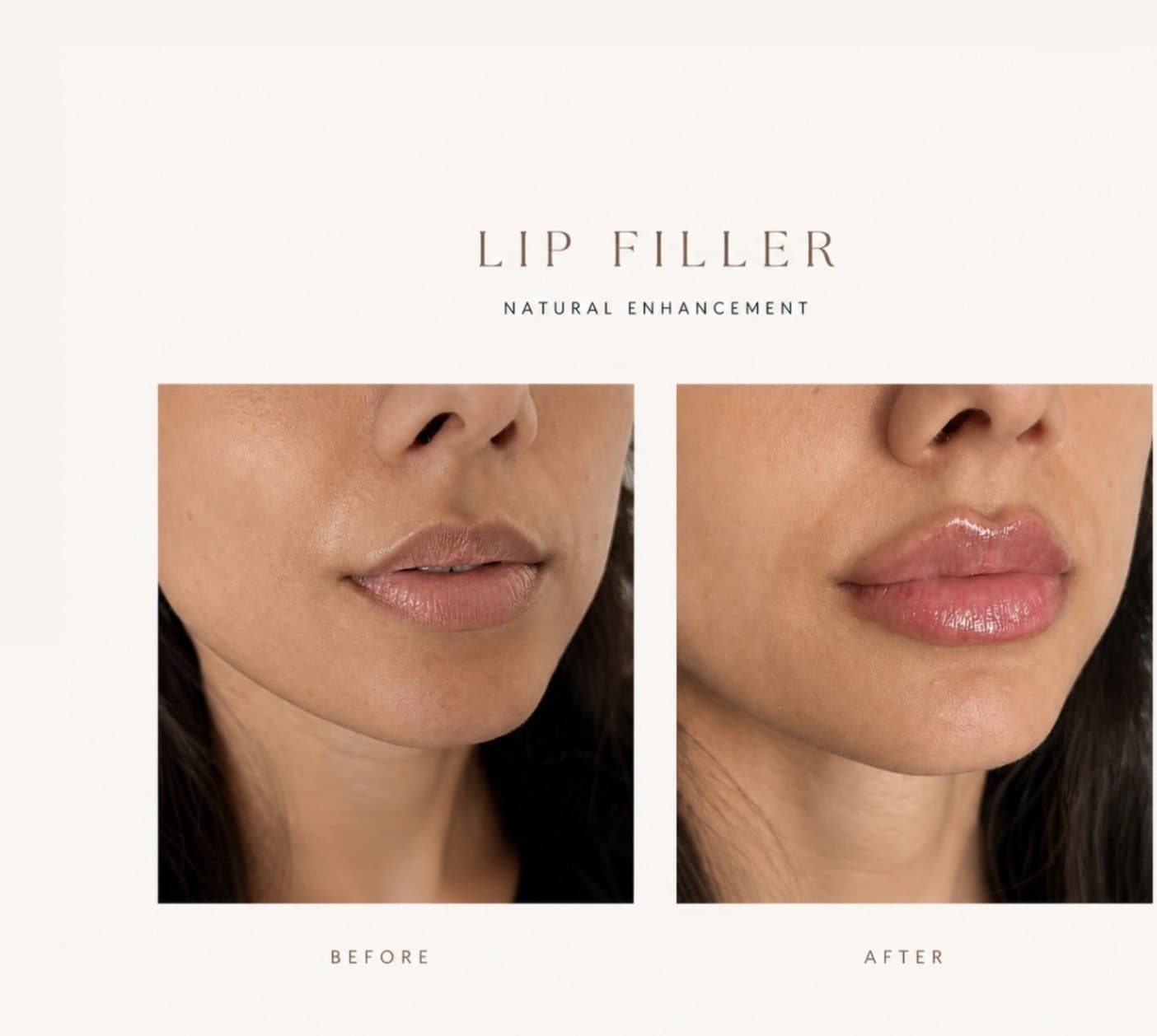 Lip filler before and after: a subtle lip enhancement by SKN Luxe Manchester